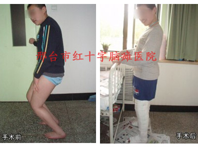 微創(chuàng)矯形手術(shù)治療小兒腦癱哪里效果好？邢臺腦癱醫(yī)院